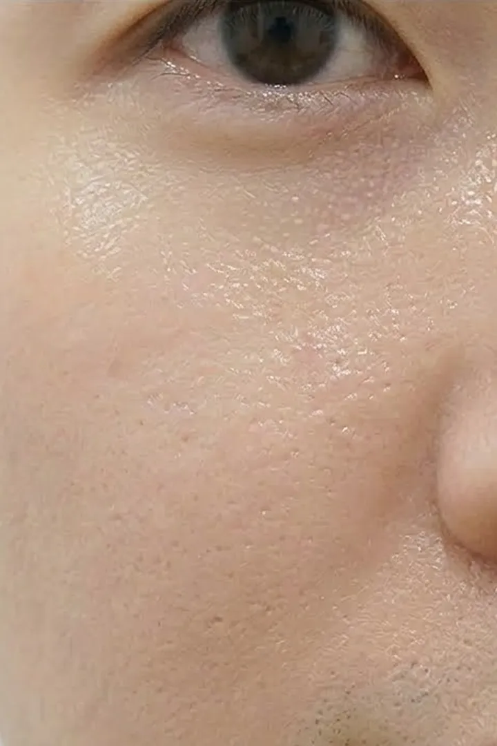 듀얼토닝 14회
색소 치료 after